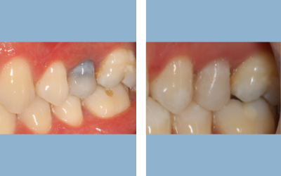 Before and After